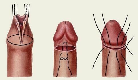 陰茎の拡大手術の本質