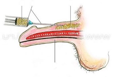 注射による陰茎の拡大