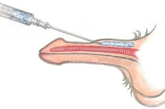 ワセリン注射を使った危険なペニス増大法